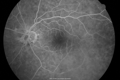 Bilateral Retinal Arteriol Occlusions - Possible Susac Syndrome 
80-year-old woman one month ago had vision loss and a vascular occlusion in the right eye.  Vision loss occurred in the left eye about 9 years ago with cotton wool spots.  Patients has a 30 year history of tinnitis.

Keywords: cotton wool;retinal artery occlusion;retinal arterial occlusion