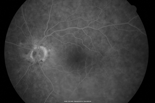 Bilateral Retinal Arteriol Occlusions - Possible Susac Syndrome 
80-year-old woman one month ago had vision loss and a vascular occlusion in the right eye.  Vision loss occurred in the left eye about 9 years ago with cotton wool spots.  Patients has a 30 year history of tinnitis.

Keywords: cotton wool;retinal artery occlusion;retinal arterial occlusion