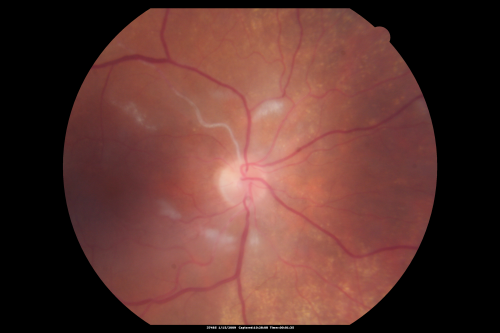 Bilateral Retinal Arteriol Occlusions - Possible Susac Syndrome 
80-year-old woman one month ago had vision loss and a vascular occlusion in the right eye.  Vision loss occurred in the left eye about 9 years ago with cotton wool spots.  Patients has a 30 year history of tinnitis.

Schlüsselwörter: cotton wool;retinal artery occlusion;retinal arterial occlusion