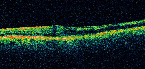 Bilateral Retinal Arteriol Occlusions - Possible Susac Syndrome 
80-year-old woman one month ago had vision loss and a vascular occlusion in the right eye.  Vision loss occurred in the left eye about 9 years ago with cotton wool spots.  Patients has a 30 year history of tinnitis.

Keywords: cotton wool;retinal artery occlusion;retinal arterial occlusion