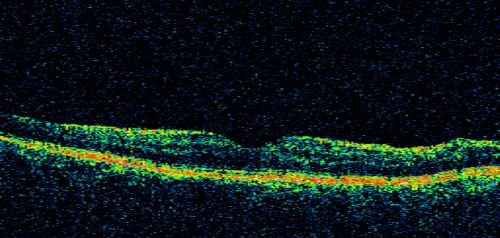 Bilateral Retinal Arteriol Occlusions - Possible Susac Syndrome 
80-year-old woman one month ago had vision loss and a vascular occlusion in the right eye.  Vision loss occurred in the left eye about 9 years ago with cotton wool spots.  Patients has a 30 year history of tinnitis.

Keywords: cotton wool;retinal artery occlusion;retinal arterial occlusion