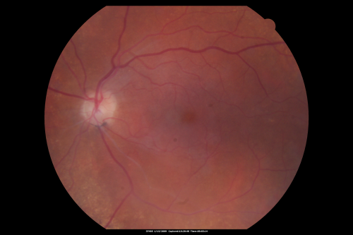 Bilateral Retinal Arteriol Occlusions - Possible Susac Syndrome 
80-year-old woman one month ago had vision loss and a vascular occlusion in the right eye.  Vision loss occurred in the left eye about 9 years ago with cotton wool spots.  Patients has a 30 year history of tinnitis.

Keywords: cotton wool;retinal artery occlusion;retinal arterial occlusion