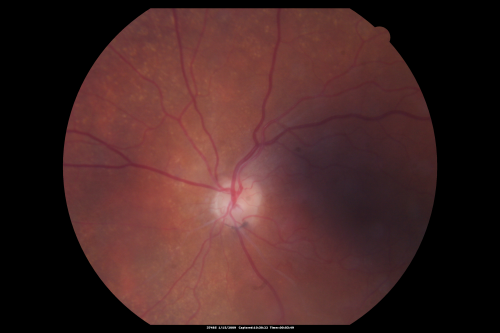 Bilateral Retinal Arteriol Occlusions - Possible Susac Syndrome 
80-year-old woman one month ago had vision loss and a vascular occlusion in the right eye.  Vision loss occurred in the left eye about 9 years ago with cotton wool spots.  Patients has a 30 year history of tinnitis.

Keywords: cotton wool;retinal artery occlusion;retinal arterial occlusion