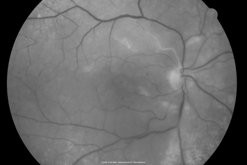 Bilateral Retinal Arteriol Occlusions - Possible Susac Syndrome 
80-year-old woman one month ago had vision loss and a vascular occlusion in the right eye.  Vision loss occurred in the left eye about 9 years ago with cotton wool spots.  Patients has a 30 year history of tinnitis.

Keywords: cotton wool;retinal artery occlusion;retinal arterial occlusion