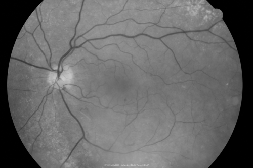 Bilateral Retinal Arteriol Occlusions - Possible Susac Syndrome 
80-year-old woman one month ago had vision loss and a vascular occlusion in the right eye.  Vision loss occurred in the left eye about 9 years ago with cotton wool spots.  Patients has a 30 year history of tinnitis.

Keywords: cotton wool;retinal artery occlusion;retinal arterial occlusion