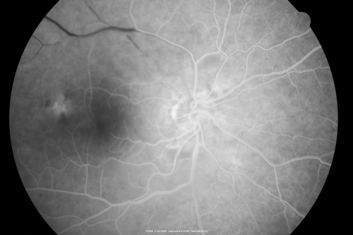Bilateral Retinal Arteriol Occlusions - Possible Susac Syndrome 
80-year-old woman one month ago had vision loss and a vascular occlusion in the right eye.  Vision loss occurred in the left eye about 9 years ago with cotton wool spots.  Patients has a 30 year history of tinnitis.

Keywords: cotton wool;retinal artery occlusion;retinal arterial occlusion