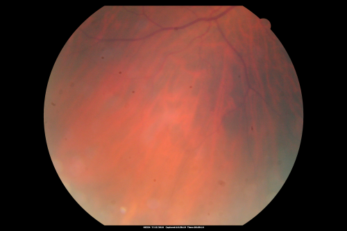 Sturge-Weber Encephalotigeminal Angiomatosis - Facial Hemangioma and Asymptomatic Ipsilateral Diffuse Choroidal Hemangioma
61-year-old man with Sturge-Weber syndrome with a hemangioma on the left side of his face. 

VISUAL ACUITY:  Vision OD is 20/50, PH 20/30; OS 20/80, PH 20/30.  IOP:  OD 16, OS 19.


