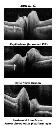 Optic Nerve (Disc) Drusen vs. Disc Edema Vs. AION - Spectral Domain Optical Coherence Tomography Line Scan
