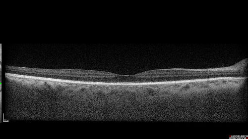 Syphilitic optic neuritis
Two weeks ago she woke up with blurred vision in the left eye.  She usually gets up at 5 AM.  Then she noticed a gray spot in the left eye that did not go away.  This is new for her.  The gray spot is not getting any better or worse in the left eye. (4/4/23)
Systemic Meds: Lisinopril 40 mg. metformin hydrochloride 1000 MG. nifedipine 30mg 
VA OD: sc20/80 PH20/50 NscJ10
VA OS: sc2'/200 Nsc20/400
IOP: TP: OD:15 OS:16 
No AC or vitreous cells - later images was with second eye involved with uveitis.  Patient received IV PCN and was lost to follow-up
