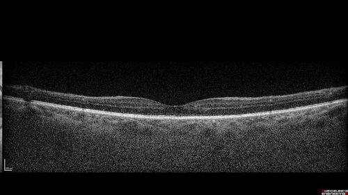 Syphilitic optic neuritis
Two weeks ago she woke up with blurred vision in the left eye.  She usually gets up at 5 AM.  Then she noticed a gray spot in the left eye that did not go away.  This is new for her.  The gray spot is not getting any better or worse in the left eye. (4/4/23)
Systemic Meds: Lisinopril 40 mg. metformin hydrochloride 1000 MG. nifedipine 30mg 
VA OD: sc20/80 PH20/50 NscJ10
VA OS: sc2'/200 Nsc20/400
IOP: TP: OD:15 OS:16 
No AC or vitreous cells - later images was with second eye involved with uveitis.  Patient received IV PCN and was lost to follow-up
