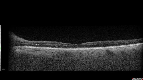 Syphilitic optic neuritis
Two weeks ago she woke up with blurred vision in the left eye.  She usually gets up at 5 AM.  Then she noticed a gray spot in the left eye that did not go away.  This is new for her.  The gray spot is not getting any better or worse in the left eye. (4/4/23)
Systemic Meds: Lisinopril 40 mg. metformin hydrochloride 1000 MG. nifedipine 30mg 
VA OD: sc20/80 PH20/50 NscJ10
VA OS: sc2'/200 Nsc20/400
IOP: TP: OD:15 OS:16 
No AC or vitreous cells - later images was with second eye involved with uveitis.  Patient received IV PCN and was lost to follow-up
