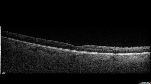Syphilitic optic neuritis
Two weeks ago she woke up with blurred vision in the left eye.  She usually gets up at 5 AM.  Then she noticed a gray spot in the left eye that did not go away.  This is new for her.  The gray spot is not getting any better or worse in the left eye. (4/4/23)
Systemic Meds: Lisinopril 40 mg. metformin hydrochloride 1000 MG. nifedipine 30mg 
VA OD: sc20/80 PH20/50 NscJ10
VA OS: sc2'/200 Nsc20/400
IOP: TP: OD:15 OS:16 
No AC or vitreous cells - later images was with second eye involved with uveitis.  Patient received IV PCN and was lost to follow-up
