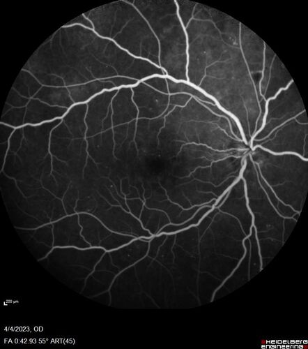Syphilitic optic neuritis
Two weeks ago she woke up with blurred vision in the left eye.  She usually gets up at 5 AM.  Then she noticed a gray spot in the left eye that did not go away.  This is new for her.  The gray spot is not getting any better or worse in the left eye. (4/4/23)
Systemic Meds: Lisinopril 40 mg. metformin hydrochloride 1000 MG. nifedipine 30mg 
VA OD: sc20/80 PH20/50 NscJ10
VA OS: sc2'/200 Nsc20/400
IOP: TP: OD:15 OS:16 
No AC or vitreous cells - later images was with second eye involved with uveitis.  Patient received IV PCN and was lost to follow-up
