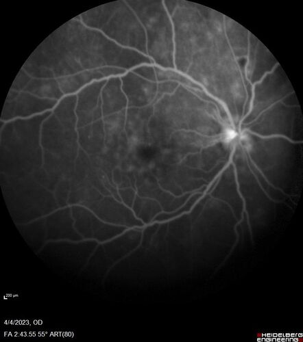 Syphilitic optic neuritis
Two weeks ago she woke up with blurred vision in the left eye.  She usually gets up at 5 AM.  Then she noticed a gray spot in the left eye that did not go away.  This is new for her.  The gray spot is not getting any better or worse in the left eye. (4/4/23)
Systemic Meds: Lisinopril 40 mg. metformin hydrochloride 1000 MG. nifedipine 30mg 
VA OD: sc20/80 PH20/50 NscJ10
VA OS: sc2'/200 Nsc20/400
IOP: TP: OD:15 OS:16 
No AC or vitreous cells - later images was with second eye involved with uveitis.  Patient received IV PCN and was lost to follow-up
