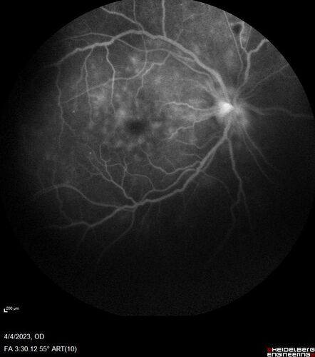 Syphilitic optic neuritis
Two weeks ago she woke up with blurred vision in the left eye.  She usually gets up at 5 AM.  Then she noticed a gray spot in the left eye that did not go away.  This is new for her.  The gray spot is not getting any better or worse in the left eye. (4/4/23)
Systemic Meds: Lisinopril 40 mg. metformin hydrochloride 1000 MG. nifedipine 30mg 
VA OD: sc20/80 PH20/50 NscJ10
VA OS: sc2'/200 Nsc20/400
IOP: TP: OD:15 OS:16 
No AC or vitreous cells - later images was with second eye involved with uveitis.  Patient received IV PCN and was lost to follow-up
