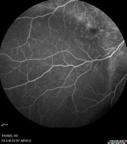 Syphilitic optic neuritis
Two weeks ago she woke up with blurred vision in the left eye.  She usually gets up at 5 AM.  Then she noticed a gray spot in the left eye that did not go away.  This is new for her.  The gray spot is not getting any better or worse in the left eye. (4/4/23)
Systemic Meds: Lisinopril 40 mg. metformin hydrochloride 1000 MG. nifedipine 30mg 
VA OD: sc20/80 PH20/50 NscJ10
VA OS: sc2'/200 Nsc20/400
IOP: TP: OD:15 OS:16 
No AC or vitreous cells - later images was with second eye involved with uveitis.  Patient received IV PCN and was lost to follow-up
