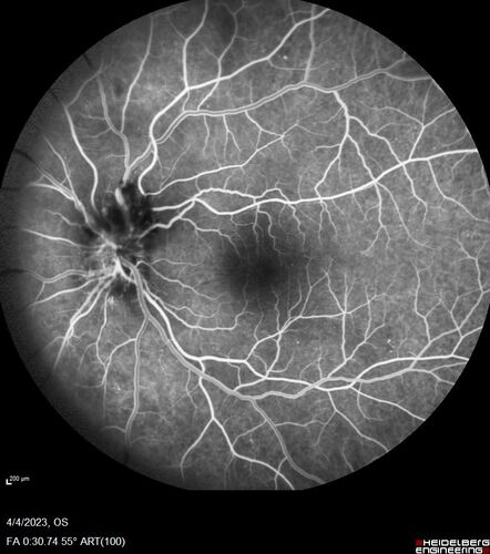 Syphilitic optic neuritis
Two weeks ago she woke up with blurred vision in the left eye.  She usually gets up at 5 AM.  Then she noticed a gray spot in the left eye that did not go away.  This is new for her.  The gray spot is not getting any better or worse in the left eye. (4/4/23)
Systemic Meds: Lisinopril 40 mg. metformin hydrochloride 1000 MG. nifedipine 30mg 
VA OD: sc20/80 PH20/50 NscJ10
VA OS: sc2'/200 Nsc20/400
IOP: TP: OD:15 OS:16 
No AC or vitreous cells - later images was with second eye involved with uveitis.  Patient received IV PCN and was lost to follow-up

