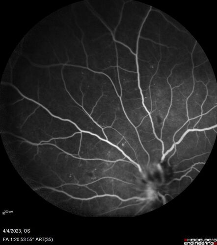 Syphilitic optic neuritis
Two weeks ago she woke up with blurred vision in the left eye.  She usually gets up at 5 AM.  Then she noticed a gray spot in the left eye that did not go away.  This is new for her.  The gray spot is not getting any better or worse in the left eye. (4/4/23)
Systemic Meds: Lisinopril 40 mg. metformin hydrochloride 1000 MG. nifedipine 30mg 
VA OD: sc20/80 PH20/50 NscJ10
VA OS: sc2'/200 Nsc20/400
IOP: TP: OD:15 OS:16 
No AC or vitreous cells - later images was with second eye involved with uveitis.  Patient received IV PCN and was lost to follow-up
