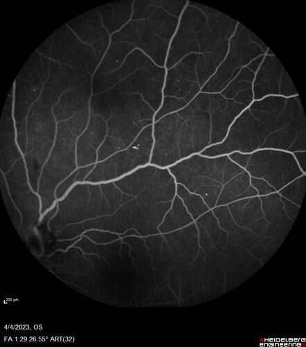 Syphilitic optic neuritis
Two weeks ago she woke up with blurred vision in the left eye.  She usually gets up at 5 AM.  Then she noticed a gray spot in the left eye that did not go away.  This is new for her.  The gray spot is not getting any better or worse in the left eye. (4/4/23)
Systemic Meds: Lisinopril 40 mg. metformin hydrochloride 1000 MG. nifedipine 30mg 
VA OD: sc20/80 PH20/50 NscJ10
VA OS: sc2'/200 Nsc20/400
IOP: TP: OD:15 OS:16 
No AC or vitreous cells - later images was with second eye involved with uveitis.  Patient received IV PCN and was lost to follow-up
