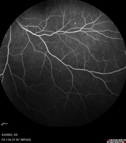 Syphilitic optic neuritis
Two weeks ago she woke up with blurred vision in the left eye.  She usually gets up at 5 AM.  Then she noticed a gray spot in the left eye that did not go away.  This is new for her.  The gray spot is not getting any better or worse in the left eye. (4/4/23)
Systemic Meds: Lisinopril 40 mg. metformin hydrochloride 1000 MG. nifedipine 30mg 
VA OD: sc20/80 PH20/50 NscJ10
VA OS: sc2'/200 Nsc20/400
IOP: TP: OD:15 OS:16 
No AC or vitreous cells - later images was with second eye involved with uveitis.  Patient received IV PCN and was lost to follow-up
