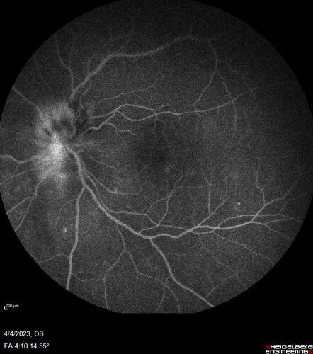 Syphilitic optic neuritis
Two weeks ago she woke up with blurred vision in the left eye.  She usually gets up at 5 AM.  Then she noticed a gray spot in the left eye that did not go away.  This is new for her.  The gray spot is not getting any better or worse in the left eye. (4/4/23)
Systemic Meds: Lisinopril 40 mg. metformin hydrochloride 1000 MG. nifedipine 30mg 
VA OD: sc20/80 PH20/50 NscJ10
VA OS: sc2'/200 Nsc20/400
IOP: TP: OD:15 OS:16 
No AC or vitreous cells - later images was with second eye involved with uveitis.  Patient received IV PCN and was lost to follow-up
