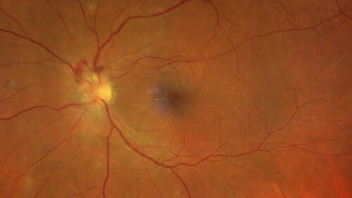 Syphilitic optic neuritis
Two weeks ago she woke up with blurred vision in the left eye.  She usually gets up at 5 AM.  Then she noticed a gray spot in the left eye that did not go away.  This is new for her.  The gray spot is not getting any better or worse in the left eye. (4/4/23)
Systemic Meds: Lisinopril 40 mg. metformin hydrochloride 1000 MG. nifedipine 30mg 
VA OD: sc20/80 PH20/50 NscJ10
VA OS: sc2'/200 Nsc20/400
IOP: TP: OD:15 OS:16 
No AC or vitreous cells - later images was with second eye involved with uveitis.  Patient received IV PCN and was lost to follow-up
