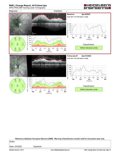 Syphilitic optic neuritis
Two weeks ago she woke up with blurred vision in the left eye.  She usually gets up at 5 AM.  Then she noticed a gray spot in the left eye that did not go away.  This is new for her.  The gray spot is not getting any better or worse in the left eye. (4/4/23)
Systemic Meds: Lisinopril 40 mg. metformin hydrochloride 1000 MG. nifedipine 30mg 
VA OD: sc20/80 PH20/50 NscJ10
VA OS: sc2'/200 Nsc20/400
IOP: TP: OD:15 OS:16 
No AC or vitreous cells - later images was with second eye involved with uveitis.  Patient received IV PCN and was lost to follow-up
