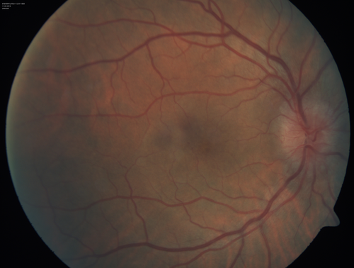 Syphillitic Optic Neuropathy and Maculopathy
46 year old woman with 2 weeks of vision loss OD.  VA 20/200 OD; 20/20 OS.  there are posterior vitreous cells on OCT in both eyes.  ICG, FAF, and FA show an abnormal macula OD.  VA improved to 20/30 within a month with treatment with PCN.
Mots-clés: syphillis