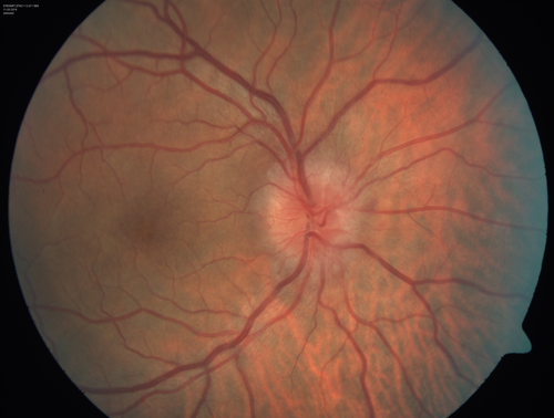 Syphillitic Optic Neuropathy and Maculopathy
46 year old woman with 2 weeks of vision loss OD.  VA 20/200 OD; 20/20 OS.  there are posterior vitreous cells on OCT in both eyes.  ICG, FAF, and FA show an abnormal macula OD.  VA improved to 20/30 within a month with treatment with PCN.
Keywords: syphillis