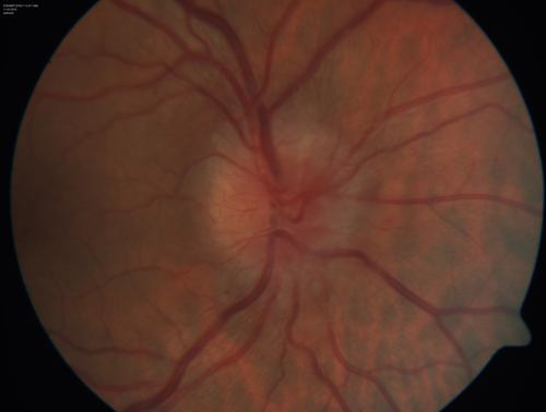 Syphillitic Optic Neuropathy and Maculopathy
46 year old woman with 2 weeks of vision loss OD.  VA 20/200 OD; 20/20 OS.  there are posterior vitreous cells on OCT in both eyes.  ICG, FAF, and FA show an abnormal macula OD.  VA improved to 20/30 within a month with treatment with PCN.
Keywords: syphillis