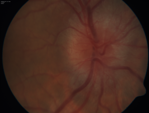 Syphillitic Optic Neuropathy and Maculopathy
46 year old woman with 2 weeks of vision loss OD.  VA 20/200 OD; 20/20 OS.  there are posterior vitreous cells on OCT in both eyes.  ICG, FAF, and FA show an abnormal macula OD.  VA improved to 20/30 within a month with treatment with PCN.
Võtmesõnad: syphillis