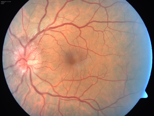 Syphillitic Optic Neuropathy and Maculopathy
46 year old woman with 2 weeks of vision loss OD.  VA 20/200 OD; 20/20 OS.  there are posterior vitreous cells on OCT in both eyes.  ICG, FAF, and FA show an abnormal macula OD.  VA improved to 20/30 within a month with treatment with PCN.
Keywords: syphillis