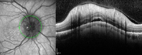 Syphillitic Optic Neuropathy and Maculopathy
46 year old woman with 2 weeks of vision loss OD.  VA 20/200 OD; 20/20 OS.  there are posterior vitreous cells on OCT in both eyes.  ICG, FAF, and FA show an abnormal macula OD.  VA improved to 20/30 within a month with treatment with PCN.
Keywords: syphillis