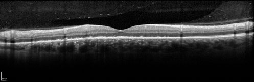 Syphillitic Optic Neuropathy and Maculopathy
46 year old woman with 2 weeks of vision loss OD.  VA 20/200 OD; 20/20 OS.  there are posterior vitreous cells on OCT in both eyes.  ICG, FAF, and FA show an abnormal macula OD.  VA improved to 20/30 within a month with treatment with PCN.
Keywords: syphillis