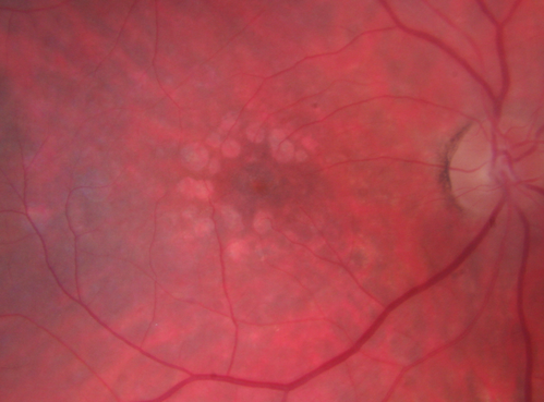 Syphilitic Chorioretinitis
Severe outer retinal atrophy and RPE non-geographic atrophy from syphilis.  Vision improved from 20/63 to 20/32 with therapy.  Images look a lot like DUSN.  Patient had several surgeries (vitrectomy for floaters, vitrectomy for macular pucker, Avastin injections and macular laser for edema) prior by other retina specialists prior to being correctly diagnosed and treated.
