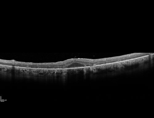 Syphilitic Chorioretinitis
Severe outer retinal atrophy and RPE non-geographic atrophy from syphilis.  Vision improved from 20/63 to 20/32 with therapy.  Images look a lot like DUSN.  Patient had several surgeries (vitrectomy for floaters, vitrectomy for macular pucker, Avastin injections and macular laser for edema) prior by other retina specialists prior to being correctly diagnosed and treated.
