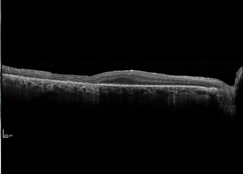 Syphilitic Chorioretinitis
Severe outer retinal atrophy and RPE non-geographic atrophy from syphilis.  Vision improved from 20/63 to 20/32 with therapy.  Images look a lot like DUSN.  Patient had several surgeries (vitrectomy for floaters, vitrectomy for macular pucker, Avastin injections and macular laser for edema) prior by other retina specialists prior to being correctly diagnosed and treated.
