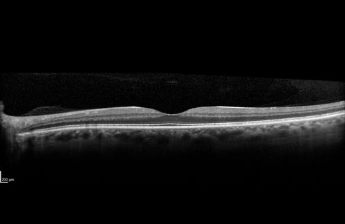 Syphilitic Chorioretinitis
Severe outer retinal atrophy and RPE non-geographic atrophy from syphilis.  Vision improved from 20/63 to 20/32 with therapy.  Images look a lot like DUSN.  Patient had several surgeries (vitrectomy for floaters, vitrectomy for macular pucker, Avastin injections and macular laser for edema) prior by other retina specialists prior to being correctly diagnosed and treated.

