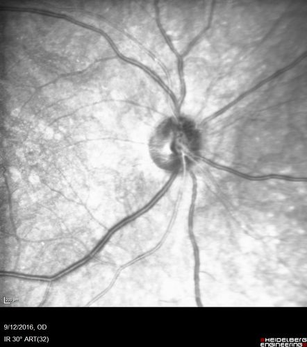 Syphilitic Chorioretinitis
Severe outer retinal atrophy and RPE non-geographic atrophy from syphilis.  Vision improved from 20/63 to 20/32 with therapy.  Images look a lot like DUSN.  Patient had several surgeries (vitrectomy for floaters, vitrectomy for macular pucker, Avastin injections and macular laser for edema) prior by other retina specialists prior to being correctly diagnosed and treated.

