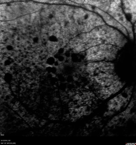 Syphilitic Chorioretinitis
Severe outer retinal atrophy and RPE non-geographic atrophy from syphilis.  Vision improved from 20/63 to 20/32 with therapy.  Images look a lot like DUSN.  Patient had several surgeries (vitrectomy for floaters, vitrectomy for macular pucker, Avastin injections and macular laser for edema) prior by other retina specialists prior to being correctly diagnosed and treated.
