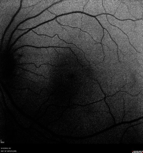 Syphilitic Chorioretinitis
Severe outer retinal atrophy and RPE non-geographic atrophy from syphilis.  Vision improved from 20/63 to 20/32 with therapy.  Images look a lot like DUSN.  Patient had several surgeries (vitrectomy for floaters, vitrectomy for macular pucker, Avastin injections and macular laser for edema) prior by other retina specialists prior to being correctly diagnosed and treated.
