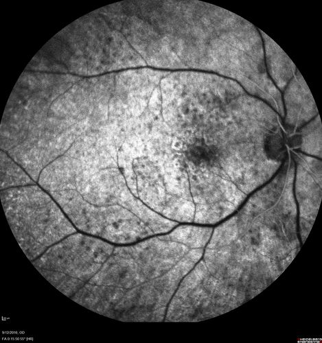 Syphilitic Chorioretinitis
Severe outer retinal atrophy and RPE non-geographic atrophy from syphilis.  Vision improved from 20/63 to 20/32 with therapy.  Images look a lot like DUSN.  Patient had several surgeries (vitrectomy for floaters, vitrectomy for macular pucker, Avastin injections and macular laser for edema) prior by other retina specialists prior to being correctly diagnosed and treated.

