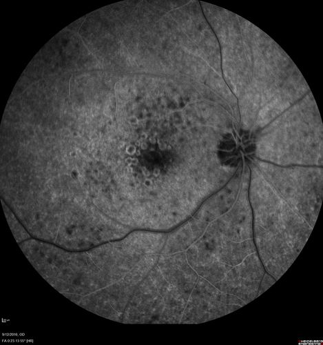 Syphilitic Chorioretinitis
Severe outer retinal atrophy and RPE non-geographic atrophy from syphilis.  Vision improved from 20/63 to 20/32 with therapy.  Images look a lot like DUSN.  Patient had several surgeries (vitrectomy for floaters, vitrectomy for macular pucker, Avastin injections and macular laser for edema) prior by other retina specialists prior to being correctly diagnosed and treated.
