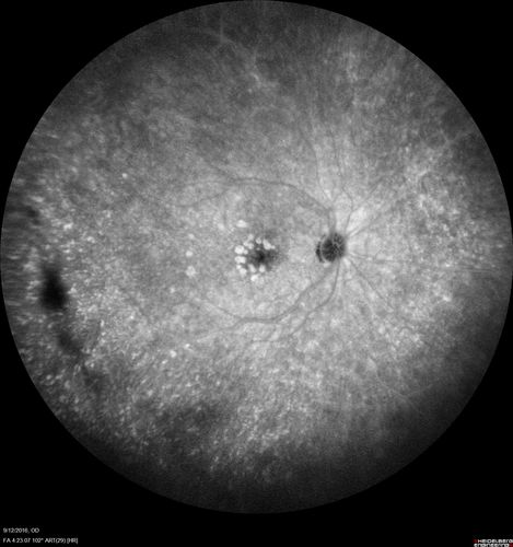Syphilitic Chorioretinitis
Severe outer retinal atrophy and RPE non-geographic atrophy from syphilis.  Vision improved from 20/63 to 20/32 with therapy.  Images look a lot like DUSN.  Patient had several surgeries (vitrectomy for floaters, vitrectomy for macular pucker, Avastin injections and macular laser for edema) prior by other retina specialists prior to being correctly diagnosed and treated.
