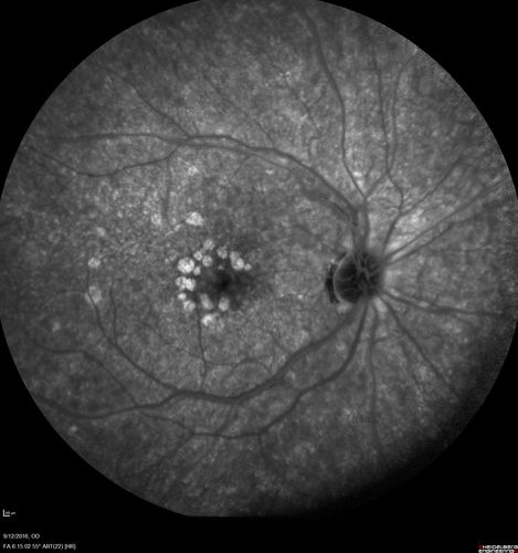 Syphilitic Chorioretinitis
Severe outer retinal atrophy and RPE non-geographic atrophy from syphilis.  Vision improved from 20/63 to 20/32 with therapy.  Images look a lot like DUSN.  Patient had several surgeries (vitrectomy for floaters, vitrectomy for macular pucker, Avastin injections and macular laser for edema) prior by other retina specialists prior to being correctly diagnosed and treated.
