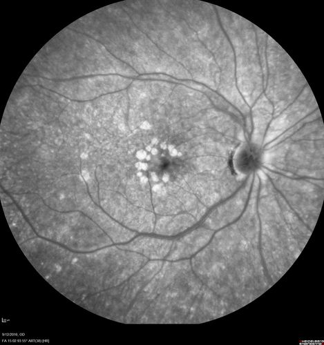 Syphilitic Chorioretinitis
Severe outer retinal atrophy and RPE non-geographic atrophy from syphilis.  Vision improved from 20/63 to 20/32 with therapy.  Images look a lot like DUSN.  Patient had several surgeries (vitrectomy for floaters, vitrectomy for macular pucker, Avastin injections and macular laser for edema) prior by other retina specialists prior to being correctly diagnosed and treated.
