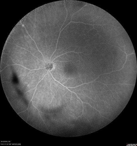 Syphilitic Chorioretinitis
Severe outer retinal atrophy and RPE non-geographic atrophy from syphilis.  Vision improved from 20/63 to 20/32 with therapy.  Images look a lot like DUSN.  Patient had several surgeries (vitrectomy for floaters, vitrectomy for macular pucker, Avastin injections and macular laser for edema) prior by other retina specialists prior to being correctly diagnosed and treated.
