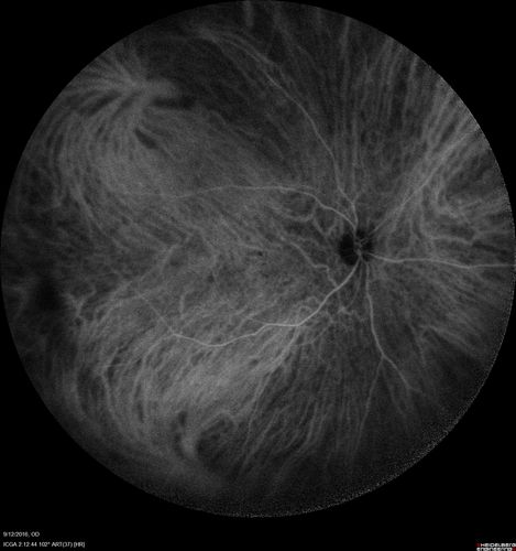 Syphilitic Chorioretinitis
Severe outer retinal atrophy and RPE non-geographic atrophy from syphilis.  Vision improved from 20/63 to 20/32 with therapy.  Images look a lot like DUSN.  Patient had several surgeries (vitrectomy for floaters, vitrectomy for macular pucker, Avastin injections and macular laser for edema) prior by other retina specialists prior to being correctly diagnosed and treated.
