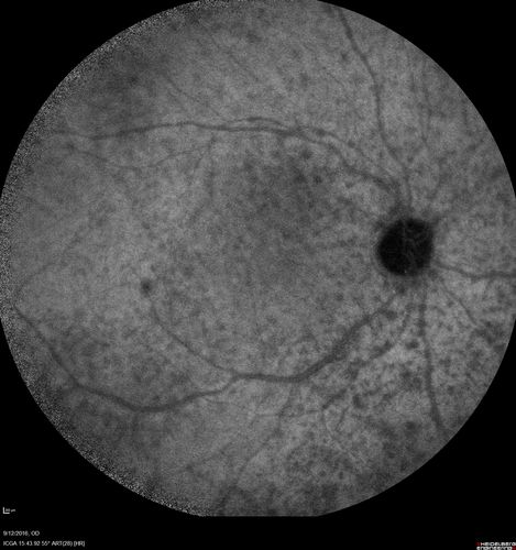 Syphilitic Chorioretinitis
Severe outer retinal atrophy and RPE non-geographic atrophy from syphilis.  Vision improved from 20/63 to 20/32 with therapy.  Images look a lot like DUSN.  Patient had several surgeries (vitrectomy for floaters, vitrectomy for macular pucker, Avastin injections and macular laser for edema) prior by other retina specialists prior to being correctly diagnosed and treated.
