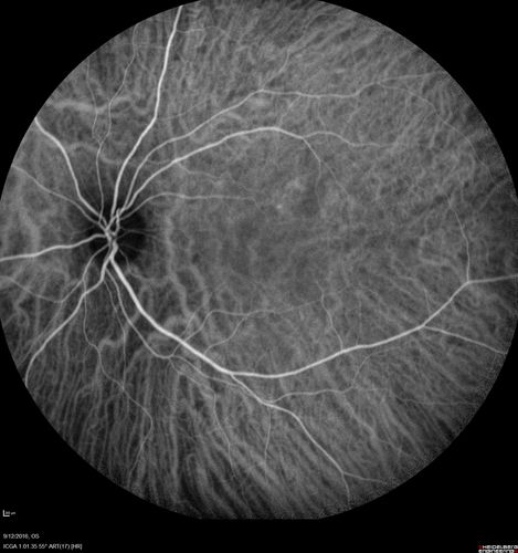 Syphilitic Chorioretinitis
Severe outer retinal atrophy and RPE non-geographic atrophy from syphilis.  Vision improved from 20/63 to 20/32 with therapy.  Images look a lot like DUSN.  Patient had several surgeries (vitrectomy for floaters, vitrectomy for macular pucker, Avastin injections and macular laser for edema) prior by other retina specialists prior to being correctly diagnosed and treated.
